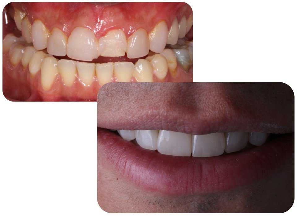 El diseño de sonrisa